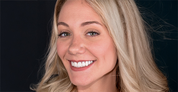 results with teeth whitening in san diego, CA